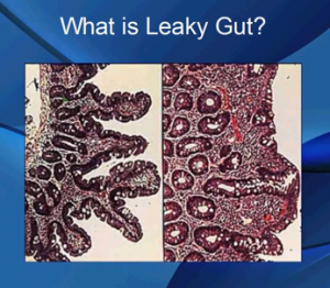 What Is A Leaky Gut