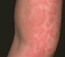 Gluten Allergy Symptom Skin Rash